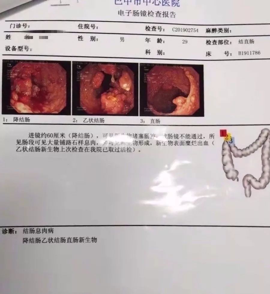 乙状结肠息肉癌症图片图片