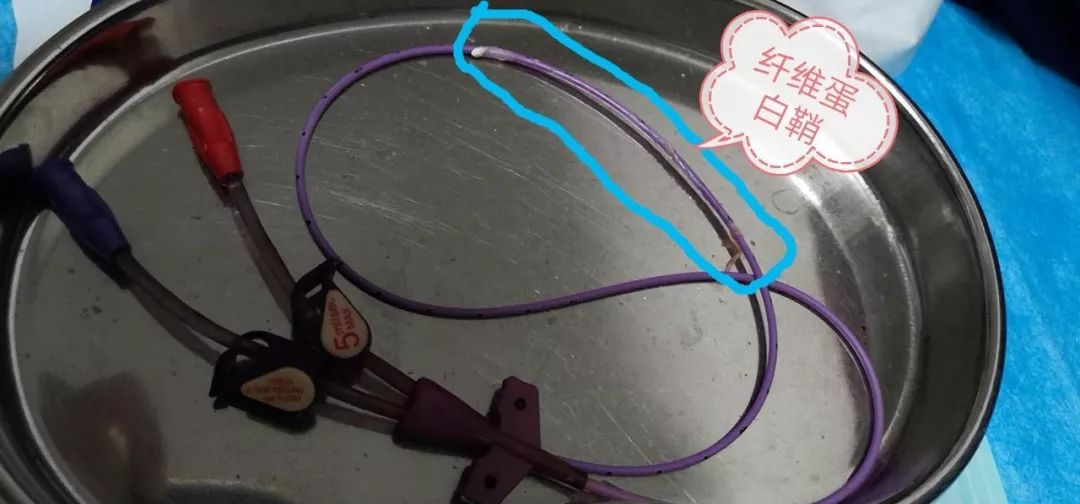 通过本案例,我们共同认识一下纤维蛋白鞘.