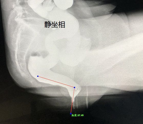 直肠前突造影图片