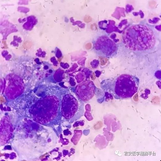 尿路移行上皮细胞癌是什么样的