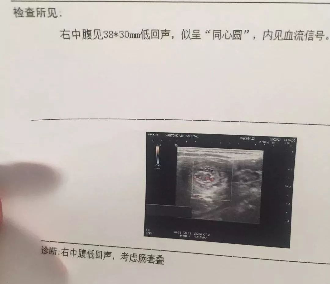 从疑似着凉到确诊肠套叠说说老母亲胆战心惊的18小时这病真的会要命