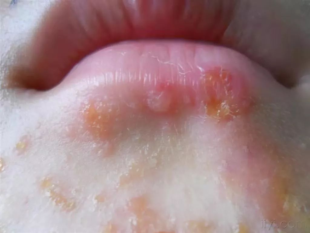 因此,热痱多发生在一些多汗的部位,如前额,颈,胸上部及一些皱褶潮湿的