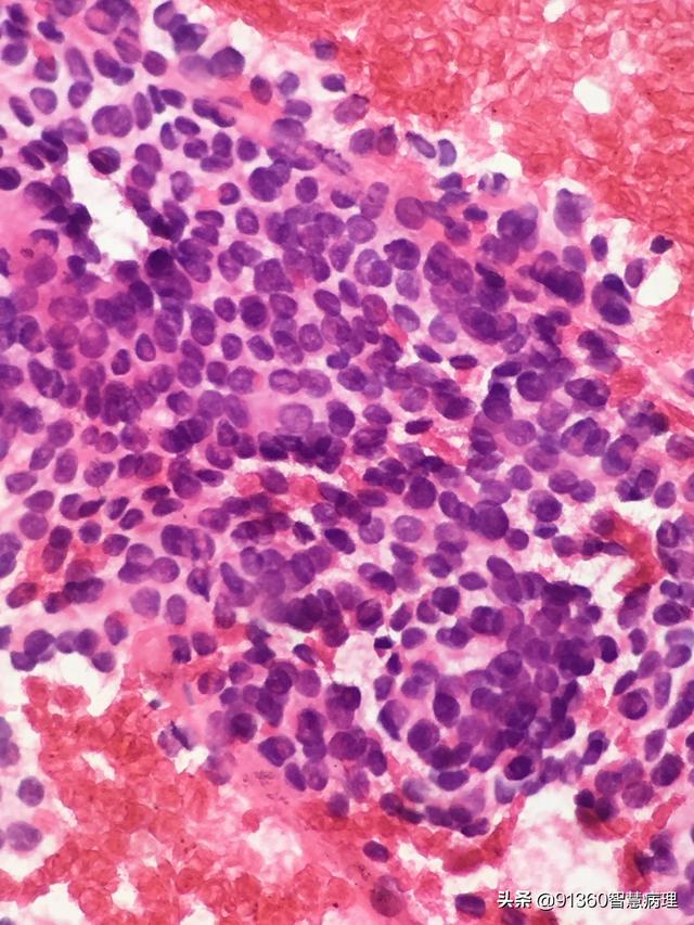 病理沙龙 | 考虑甲状腺乳头状癌?