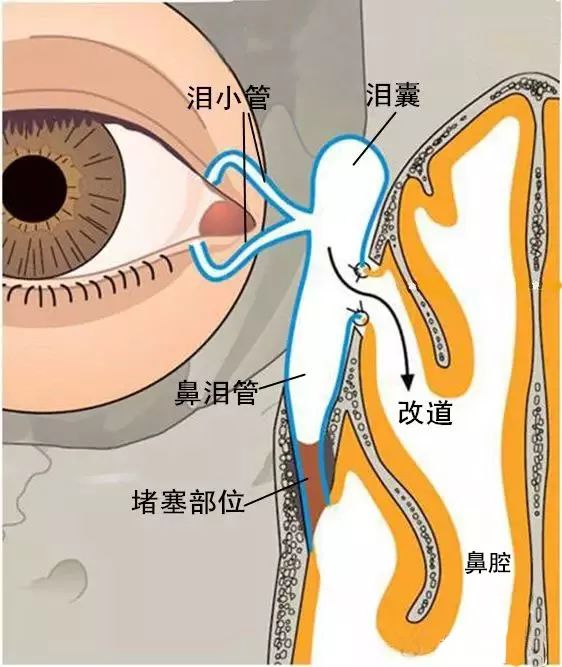 眼睛从流泪到流脓,当心会有失明风险