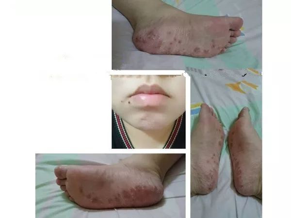 成人患手足口病:脚底长满水泡,比剖腹产还痛_大人