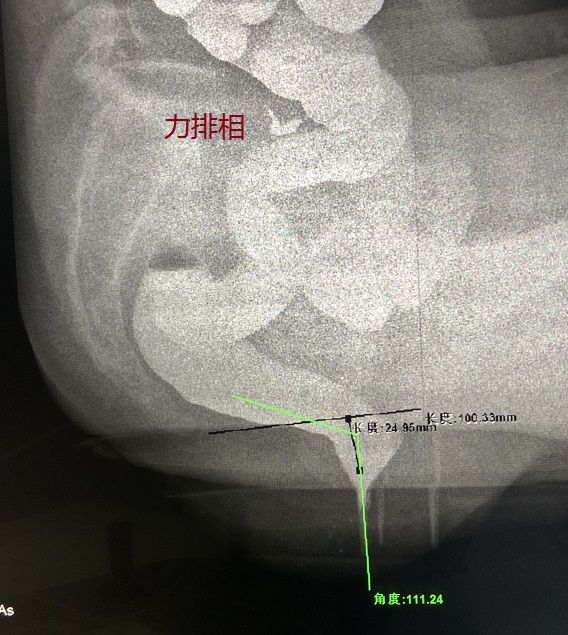 正常排粪造影图片图片