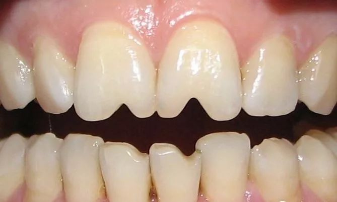 小孩牙齿为什么呈锯齿状