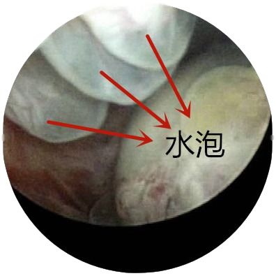 稽留流产合并水泡孕囊布满微血栓稽留流产合并子宫内膜息肉12术后宫腔