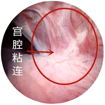 宫腔粘连重度图片图片