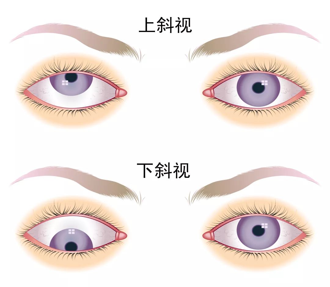 垂直性斜视图片 双眼图片