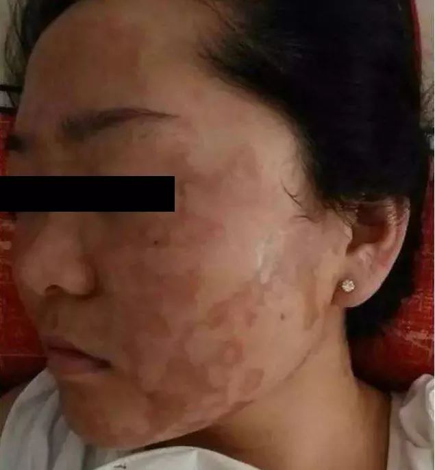 皮肤汞中毒症状图片图片