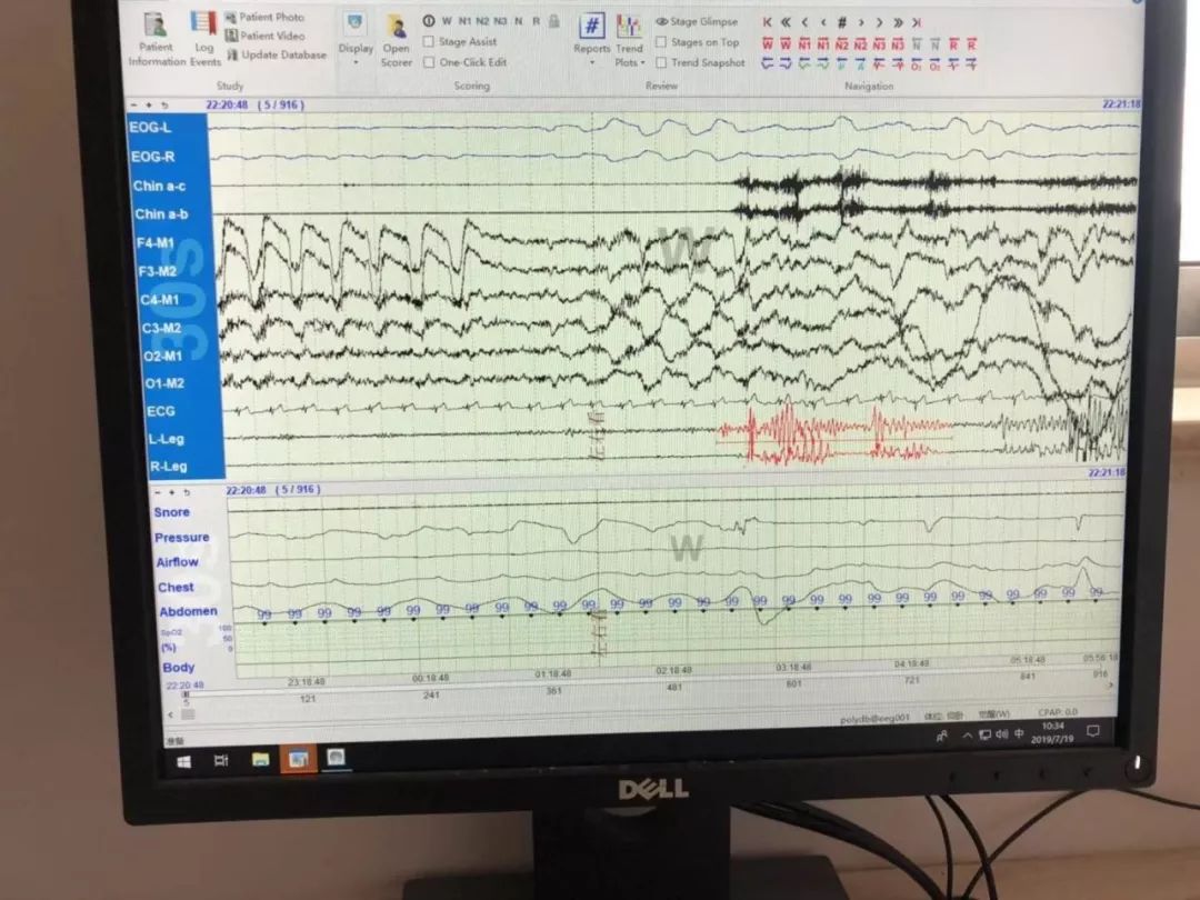 去医院睡觉我国3亿人存在睡眠障碍600号首开睡眠病房医生睡不着只是