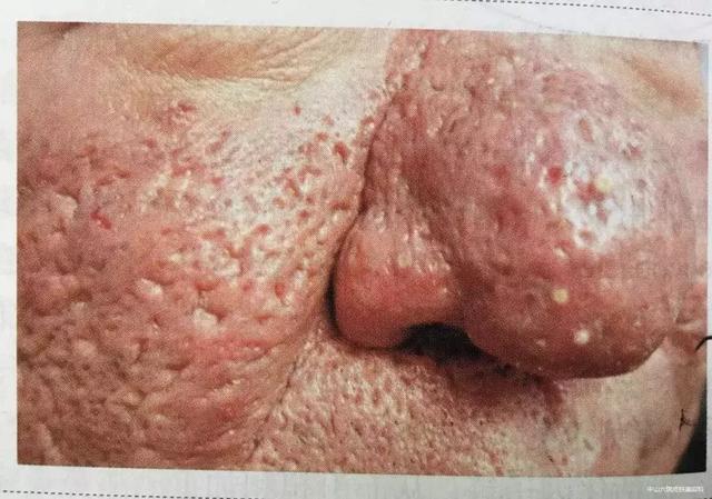 有黑头,草莓鼻怎么办?祛黑头方法大盘点,最有效的是这个.