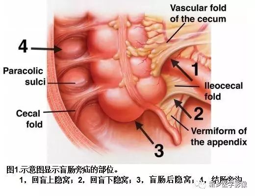 乙状结肠周围疝约占全部内疝的6%,分为三种类型即乙状结肠间疝,经乙状