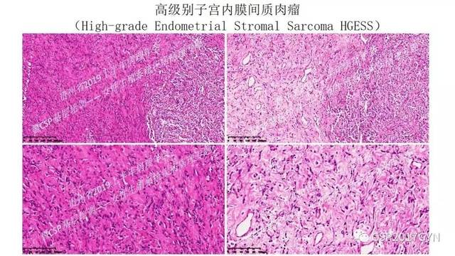 中華病理學會基層培訓遵義站講座六子宮內膜間質腫瘤的病理診斷及鑑別