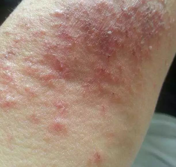 预防登革热防控罪魁祸首花蚊子看这里