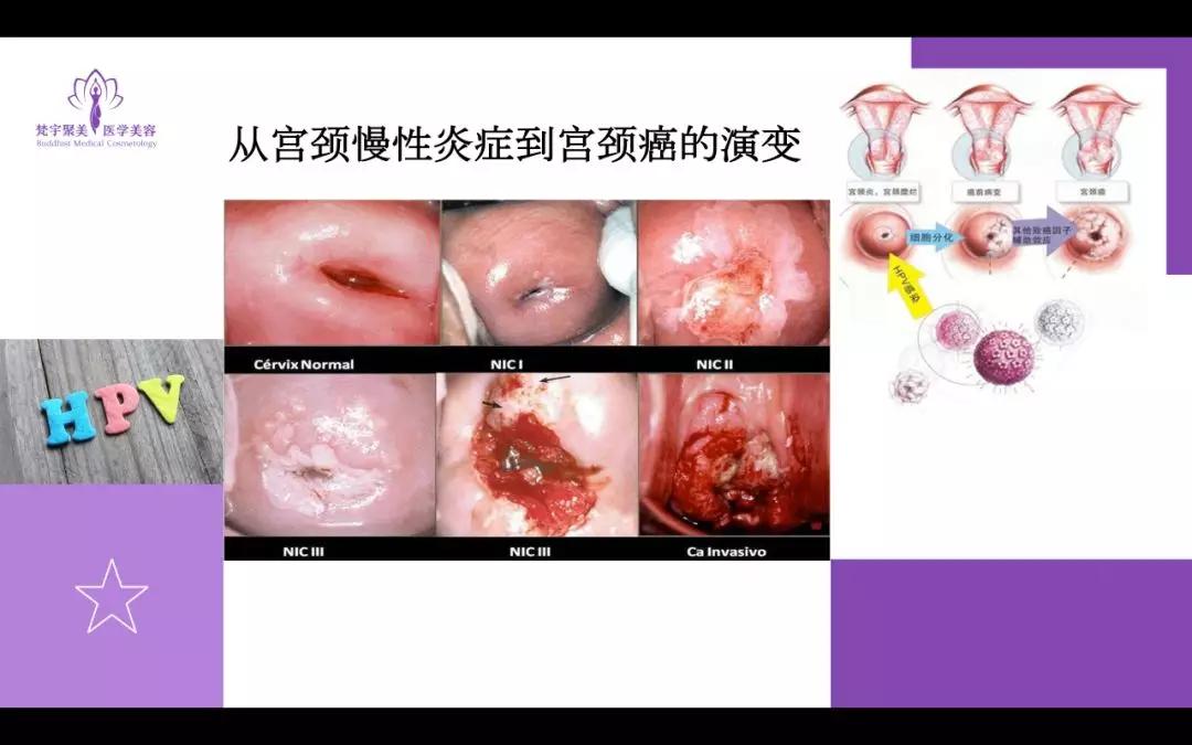 梵宇聚美女人如花生殖如根远离hpv