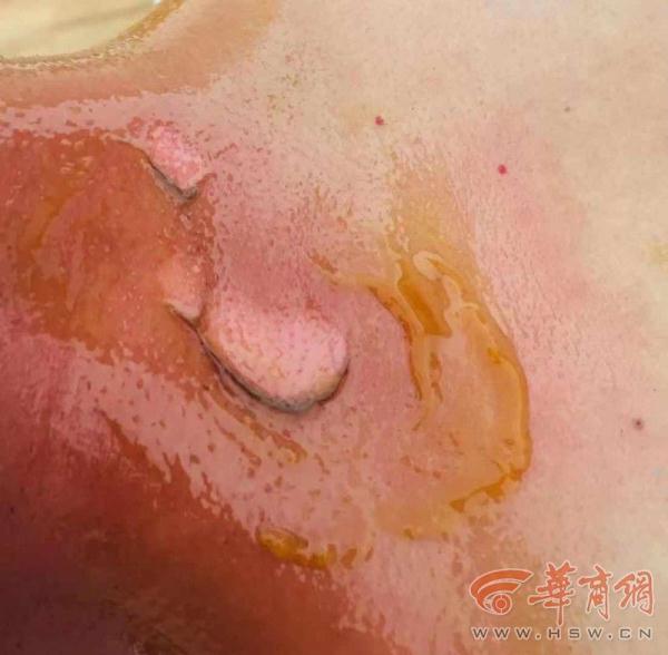 西安市民拔火罐被烫伤 负责人称:休假期间不接受采访