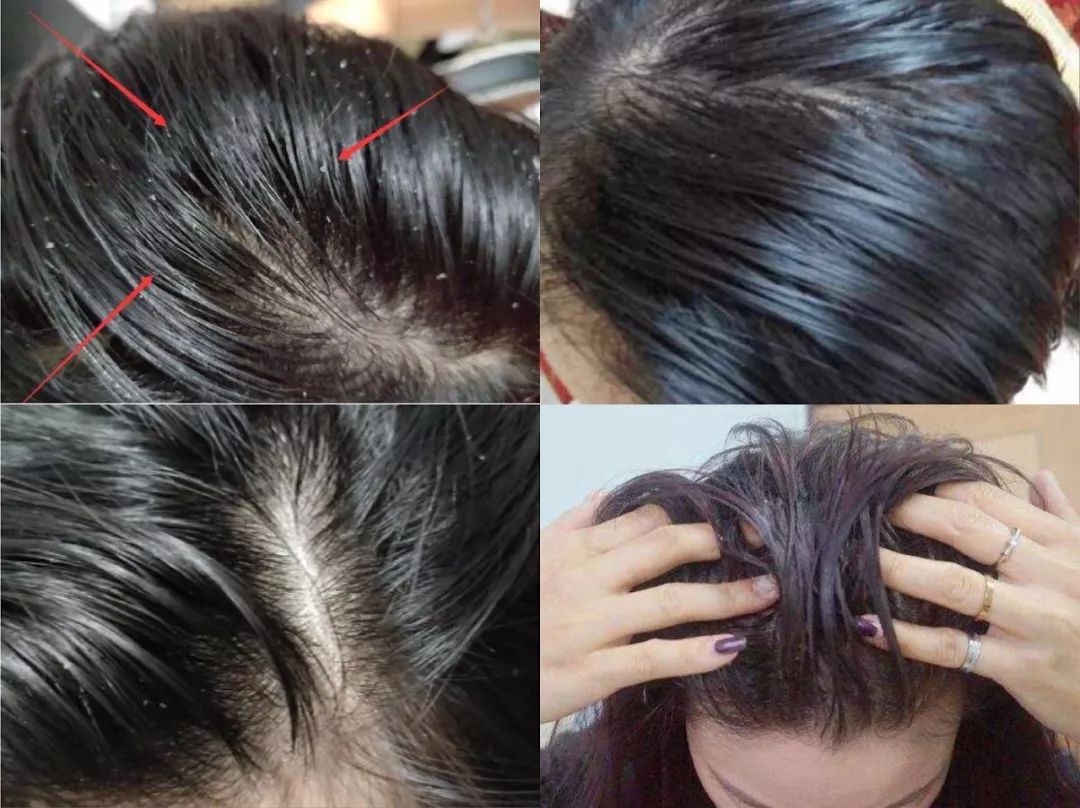 头油,头痒,脱发?教你一招,快速生发变浓密