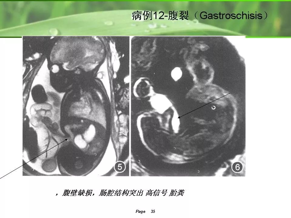 孕妇做核磁共振胎儿图图片