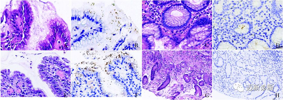 免疫组化染色与0166c尿素呼气试验在幽门螺杆菌相关胃炎诊断中的