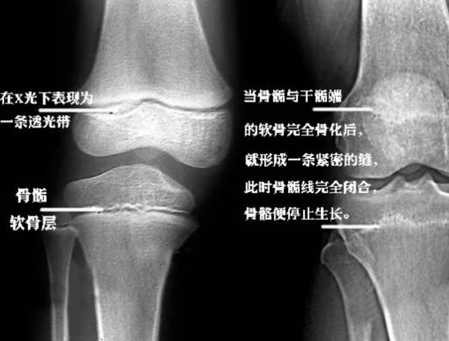 骨骺线在哪个位置图片图片