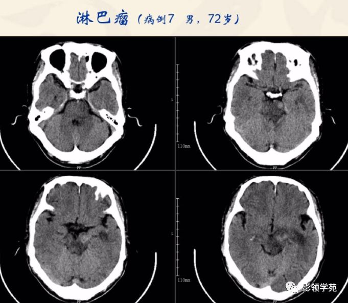 颅内淋巴瘤图片