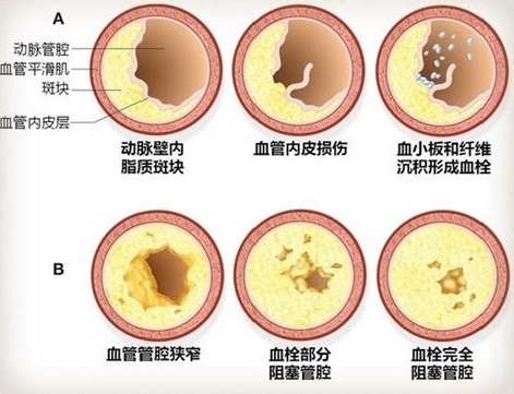 动脉硬化动脉粥样硬化动脉斑块它们是一回事吗今天终于清楚了