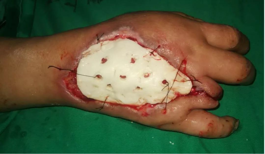 走进临床02期丨糖尿病手坏疽的诊治与防控