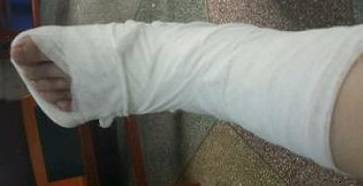 u型或管型石膏四,注意事项:1,瘀斑有时在扭伤后2-3天才出现,出现瘀斑