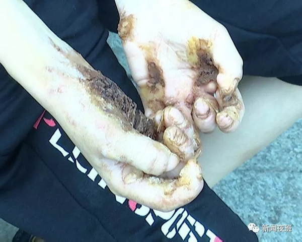 男孩患"树人"怪病求医13年未果,媒体报道后传来好消息