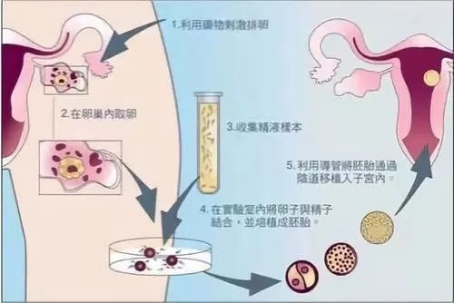 女性取卵过程图片