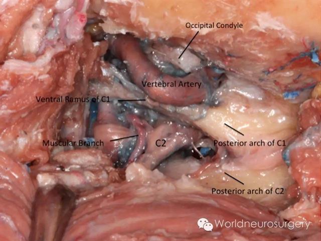 圖為移除c1和c2椎板外側後,枕下三角所見.