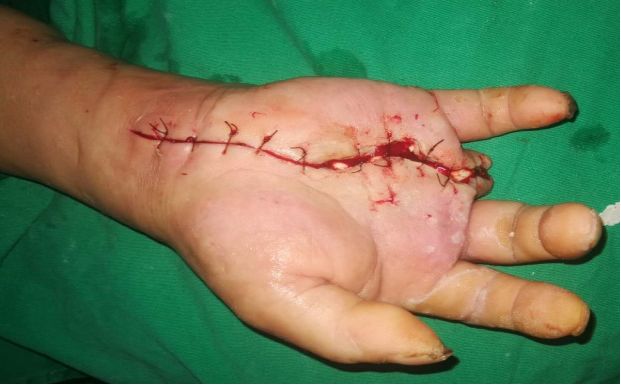 走进临床02期丨糖尿病手坏疽的诊治与防控