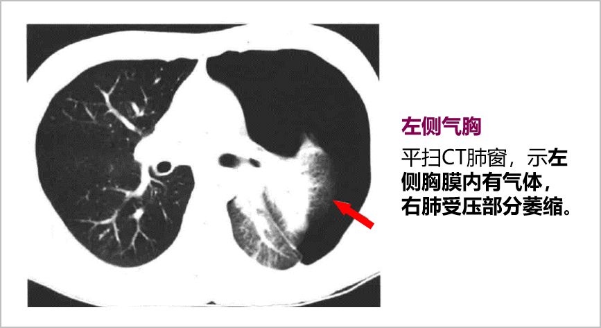 胸膜增厚ct图片怎么看图片