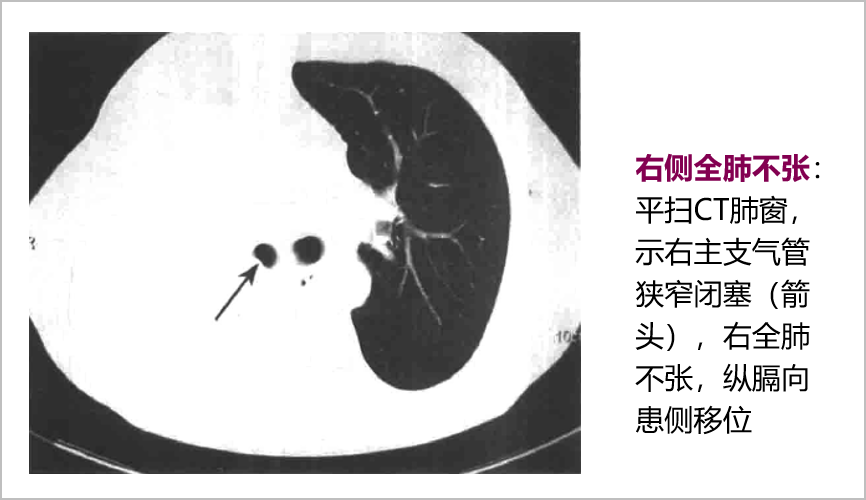 胸部常见病变ct影像解读_胸膜