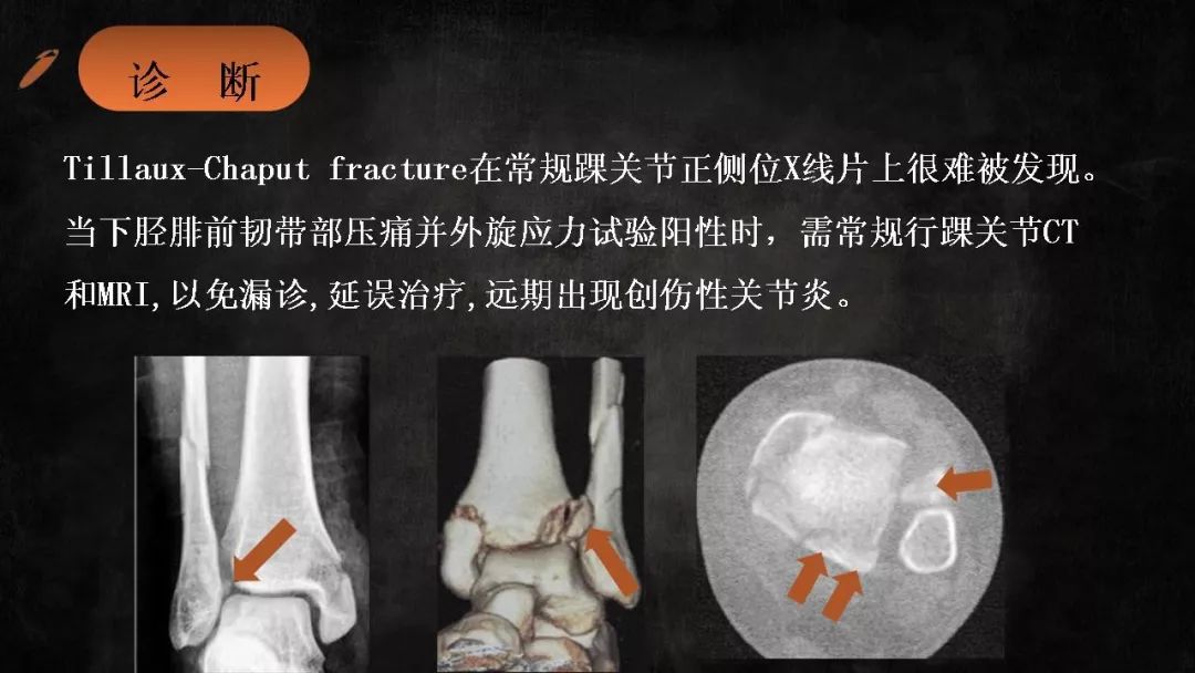 特殊类型的踝关节骨折(二)丨影像天地