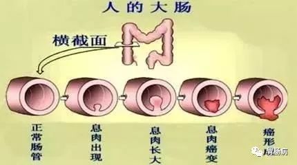 全面解读结直肠息肉你想知道的都在这里