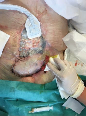 直肠癌造瘘手术图片