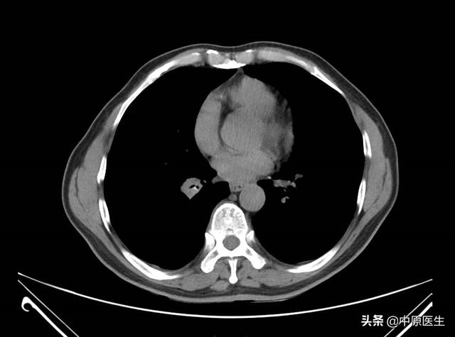 男子反复发烧肺部有阴影治疗无效以为是重病被细心专家发现原因