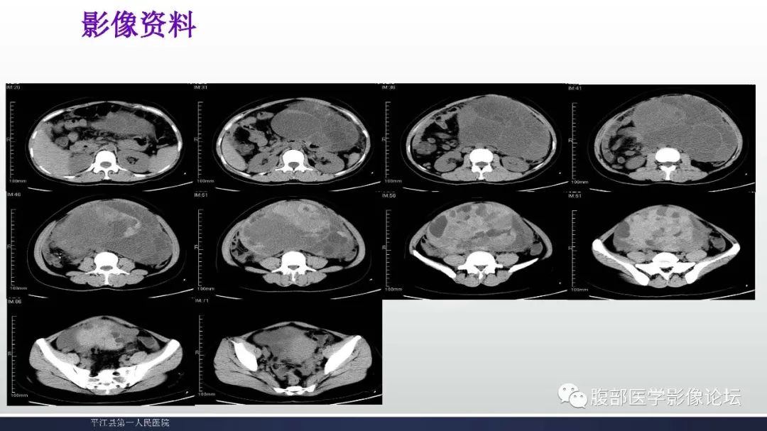 卵巢黏液性囊腺瘤影像表现