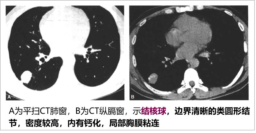 胸膜炎ct图片表现图片