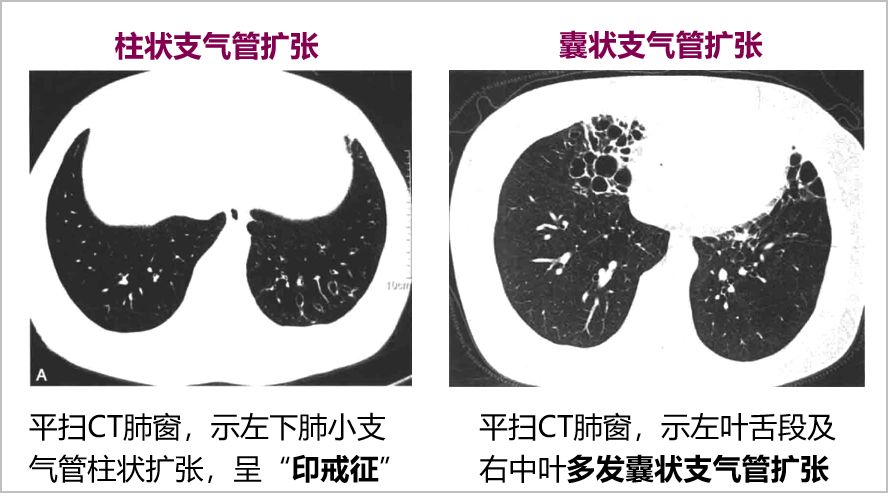 6大叶性肺炎37间质性肺炎38肺脓肿39肺结核310肺癌311胸腔积液3