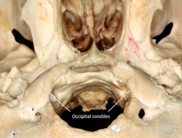 神經外科醫生可以確認解剖標誌以避免神經血管損傷,特別是椎動脈和