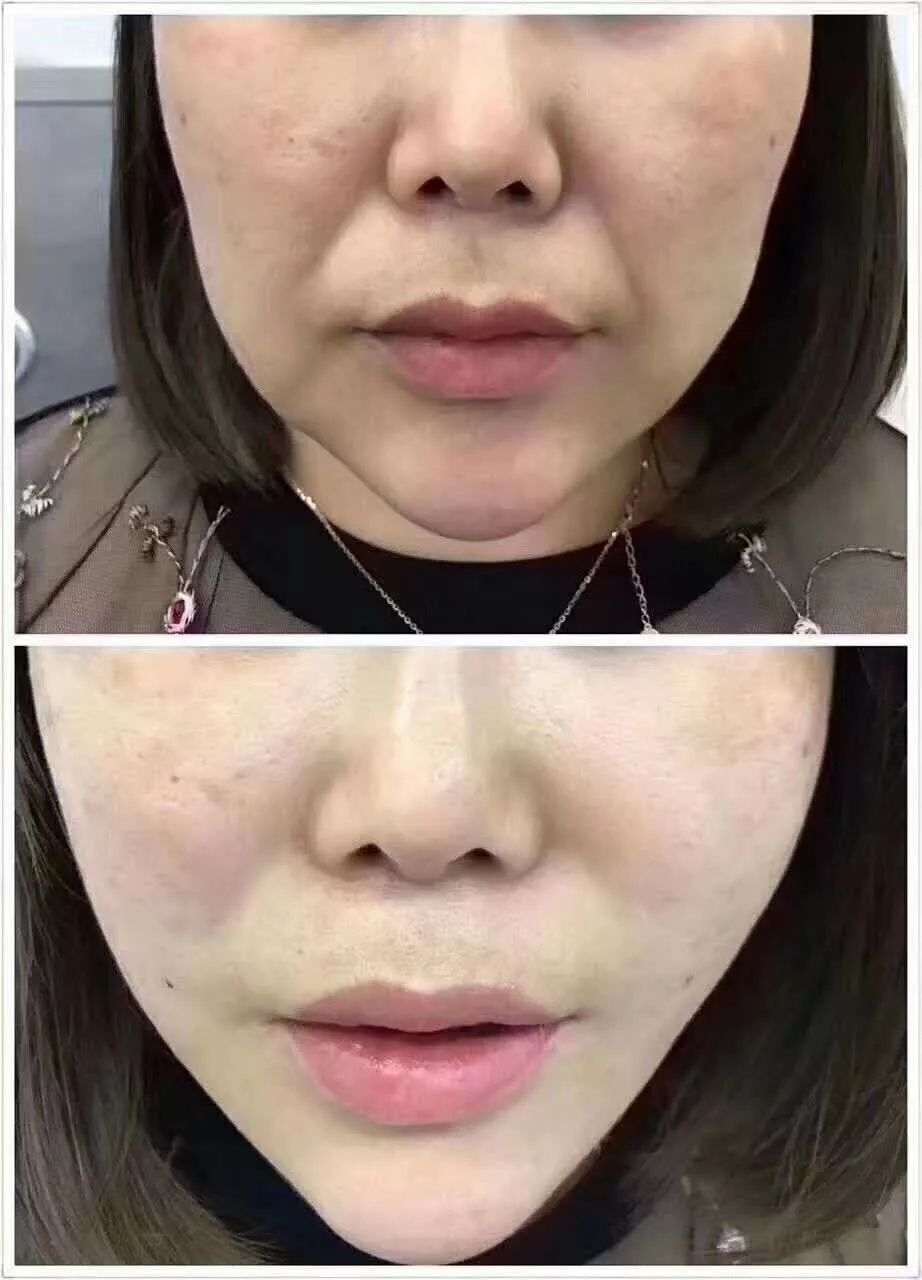第二次做线雕的心态:到处对比案例