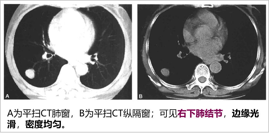 胸部常见病变ct影像解读_胸膜