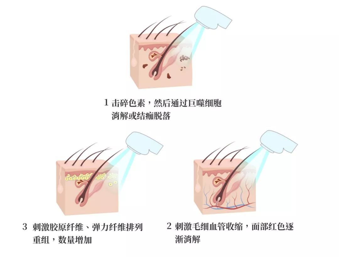 光子嫩肤的原理就是通过光照射入皮肤,通过"不同长度的光"选择性的