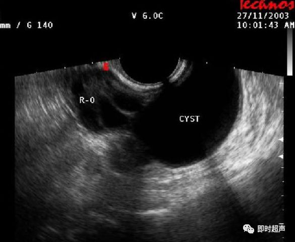 卵巢肿瘤的超声诊断