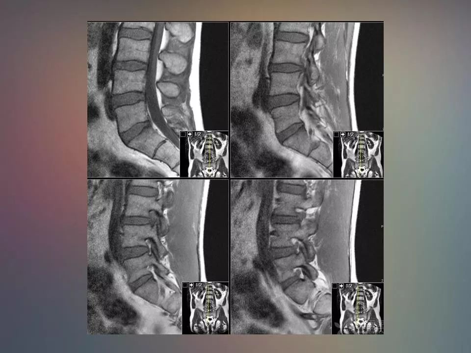 腰椎退行性变腰痛的mr诊断丨影像天地