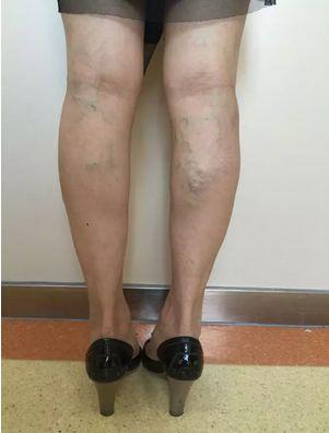 下肢静脉曲张患者在生活中如何缓解